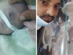 Seorang Bayi Lahir di Yaman Bermata Satu