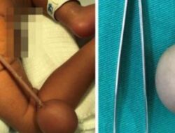 Bayi di Brasil Lahir dengan Ekor Sepanjang 12 Sentimeter